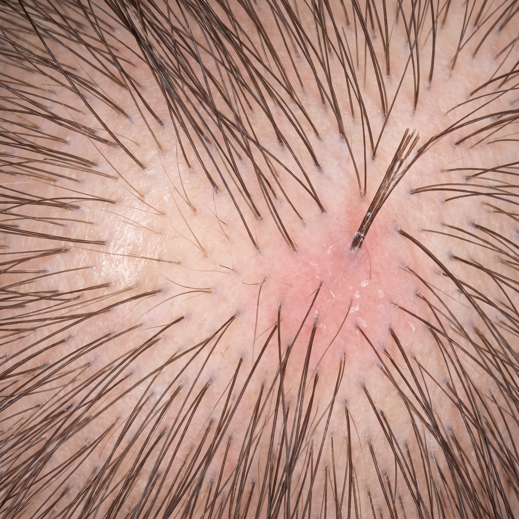 Magnified trichoscopy image of a scalp showing hair follicles, fine miniaturised hairs, mild redness with flaking and a split hair shaft