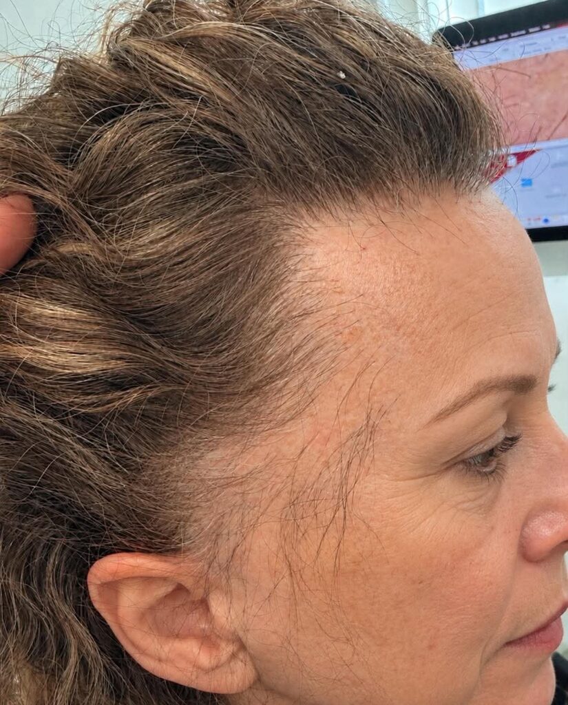 Thinning hair at a woman’s temple and front hairline, seen from the side