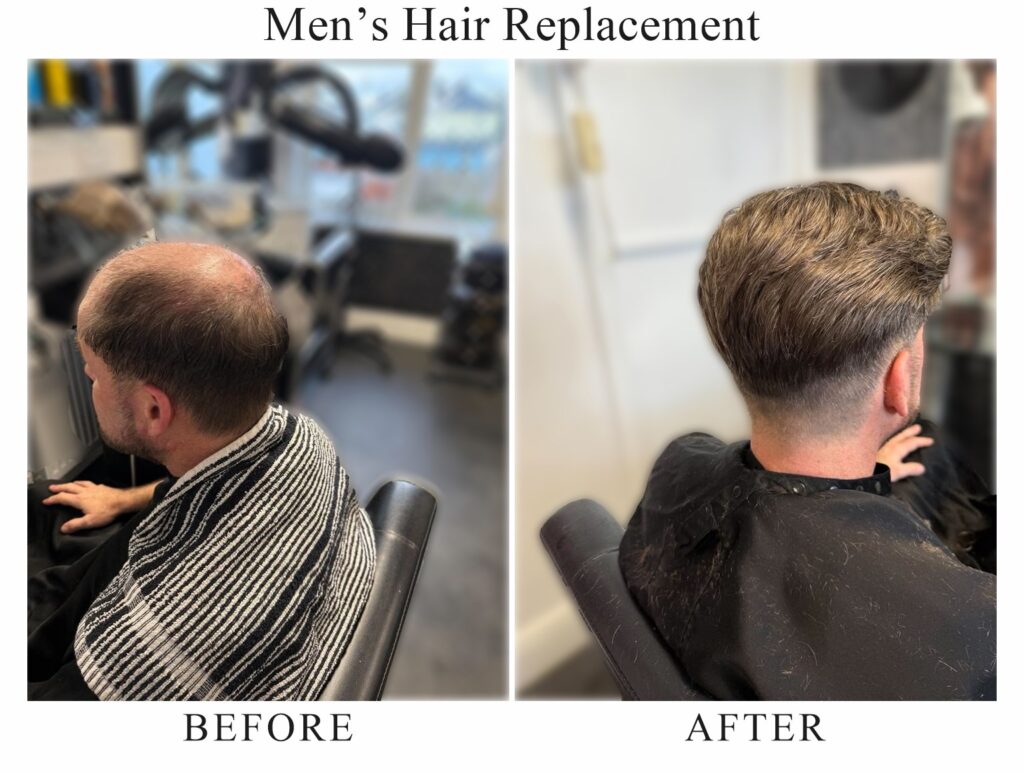 Men’s hair replacement, before and after: thinning hair on the crown, then a full, natural-looking head of hair
