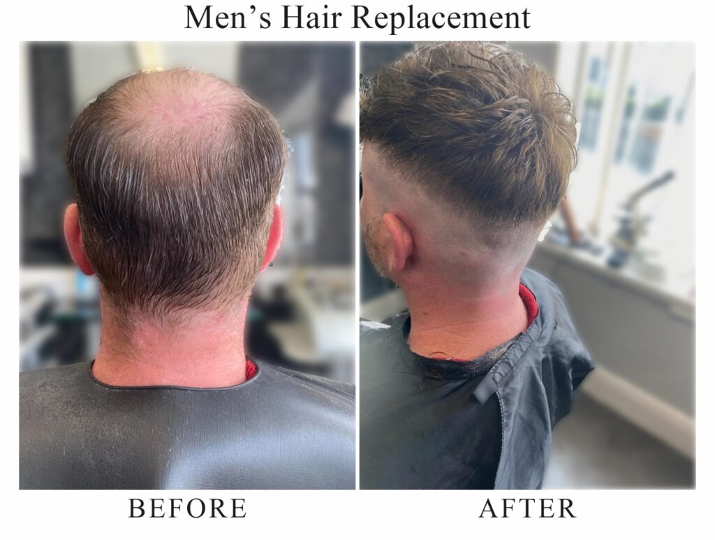 Men’s hair replacement, before and after: a thinning crown from behind, then full, textured hair with a skin fade