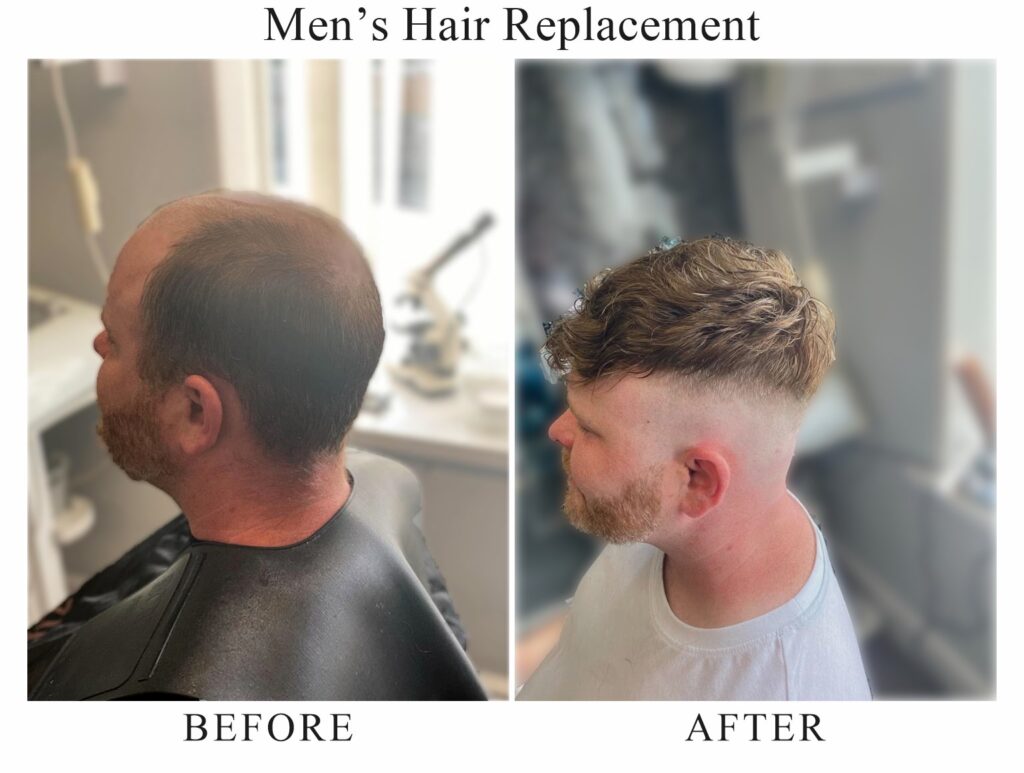 Men’s hair replacement, before and after: thinning hair from the side, then a full, textured crop with a skin fade