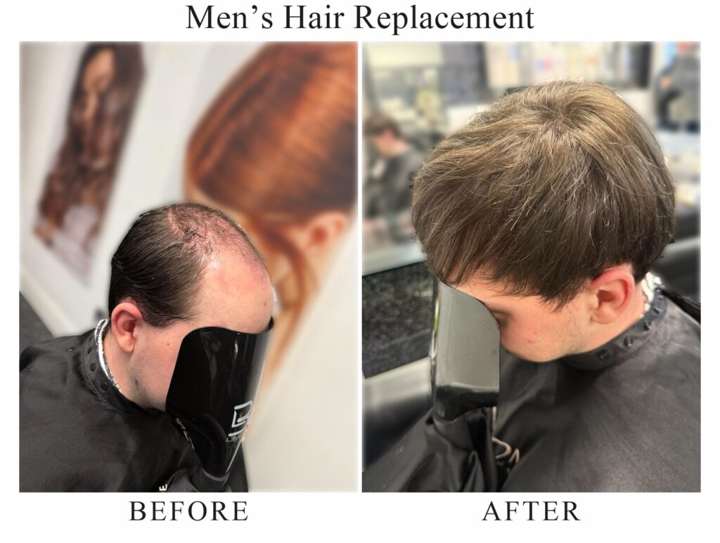 Men’s hair replacement, before and after: a receding, thinning front, then a full fringe