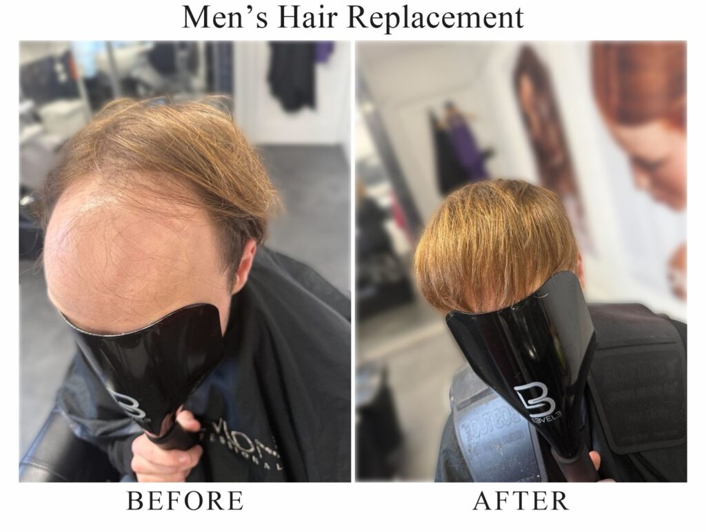 Men’s hair replacement, before and after: a bald front and crown, then a full head of hair