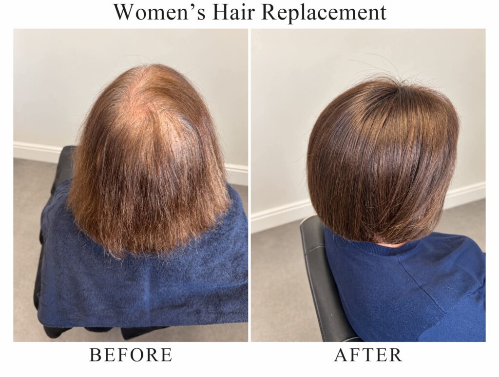 Women’s hair replacement, before and after: thinning on the crown, then a full, glossy brown bob