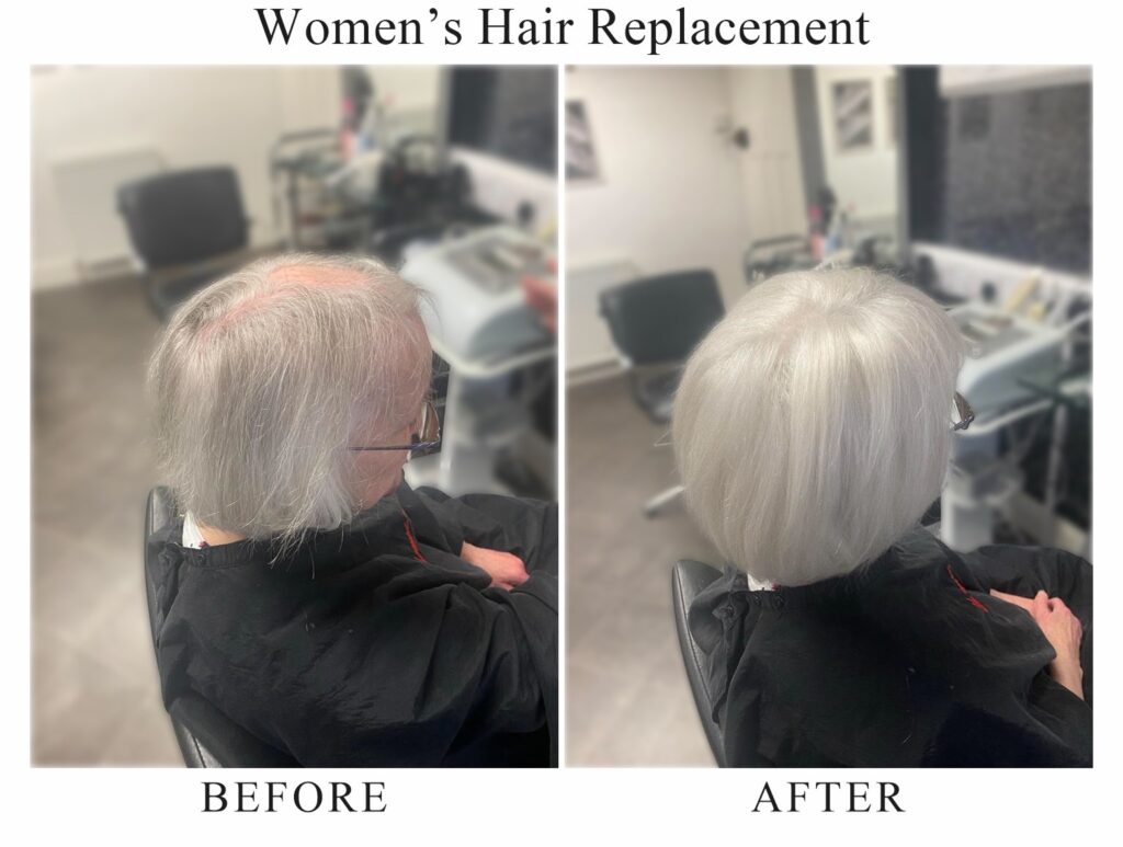 Women’s hair replacement, before and after: thin grey hair, then a full silver bob