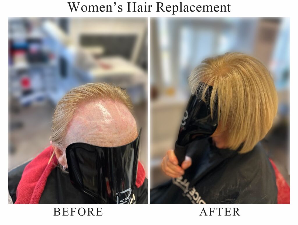 Women’s hair replacement, before and after: thinning at the front of the scalp, then a full blonde bob