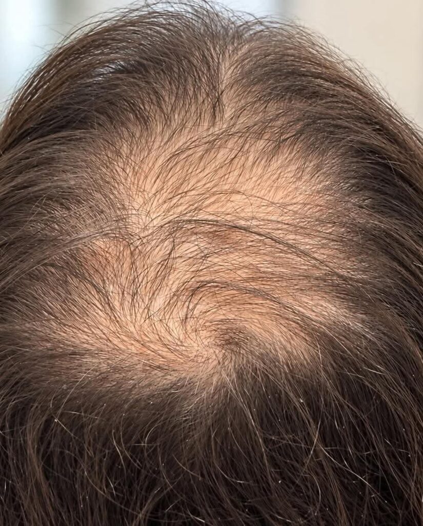 Top-down view of hair thinning at the crown, with the scalp showing through